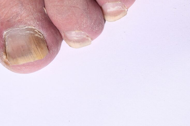 o estágio inicial da micose das unhas dos pés