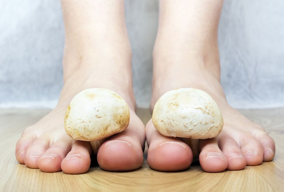 Fungo comum nas unhas dos pés