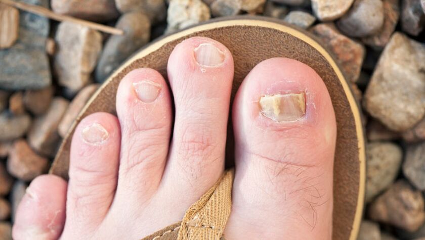 Onicomicose das unhas